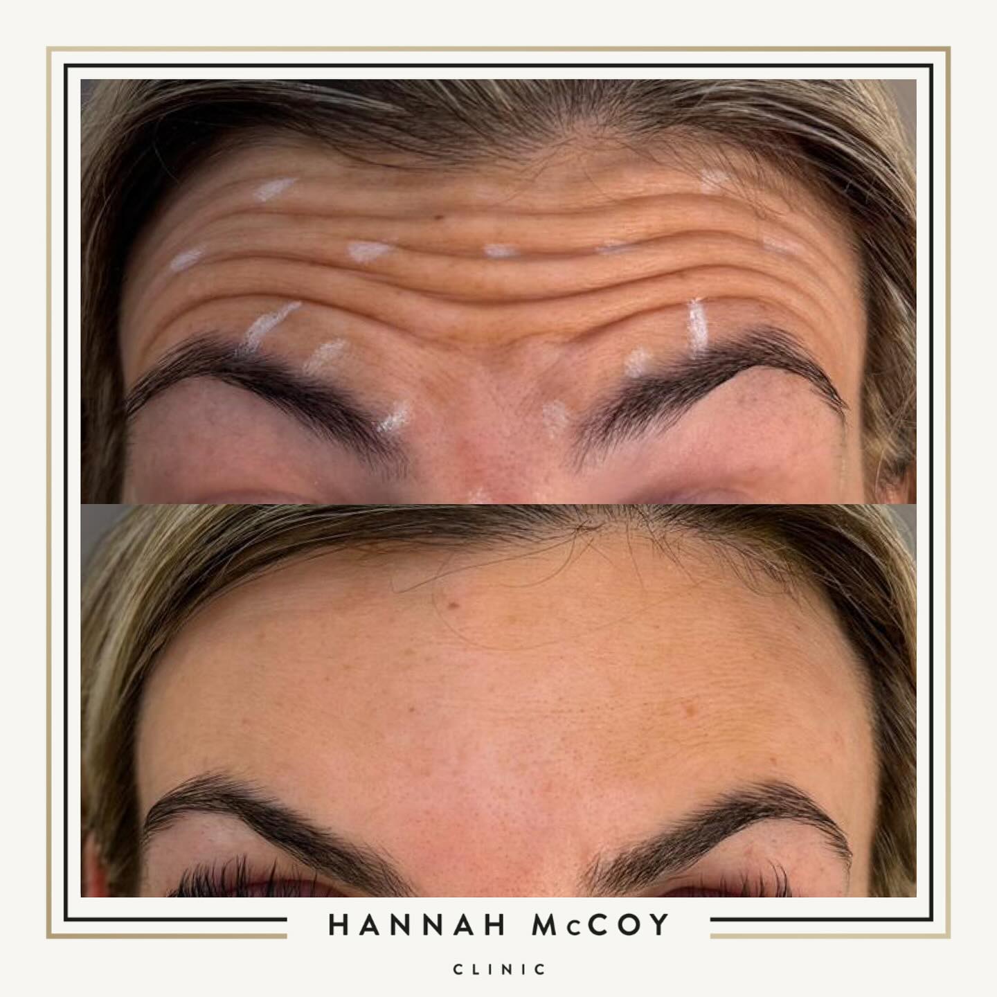 Anti-Wrinkle