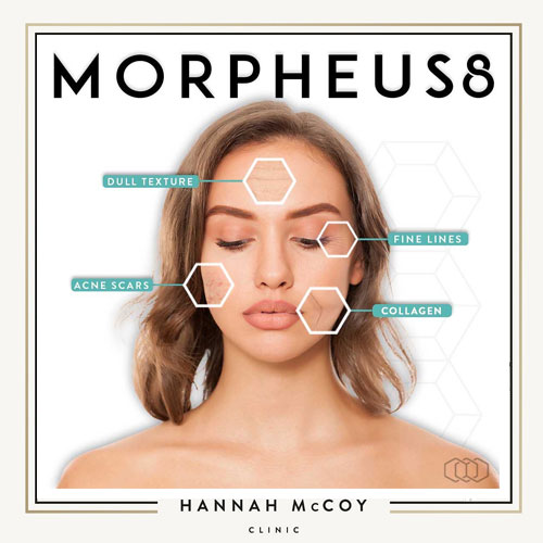 Morpheus8 Treatment 3