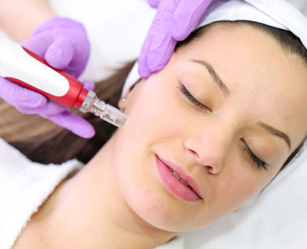 Microneedling Liverpool