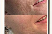 HOW OFTEN SHOULD YOU GET MICRONEEDLING