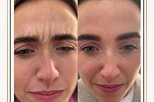 CAN YOU HAVE MICRONEEDLING AFTER BOTOX