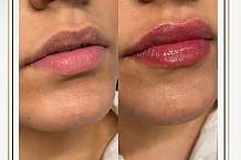 DOES LIP FILLER HURT