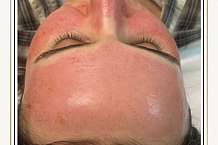 DOES MICRONEEDLING HELP ACNE