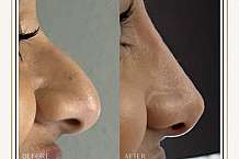 HOW LONG DOES NON SURGICAL RHINOPLASTY LAST