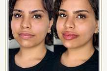 HOW TO REDUCE SWELLING AFTER LIP FILLER