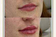 Lip Filler Swelling Stages What to Expect