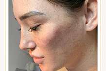 WHAT IS CHEEK ENHANCEMENT