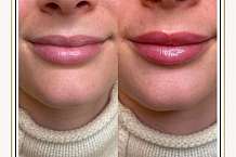 HOW TO PREPARE FOR LIP FILLERS HANNAH MCCOY CLINIC