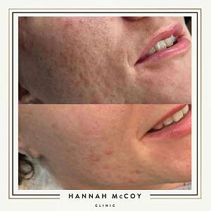HOW OFTEN SHOULD YOU GET MICRONEEDLING