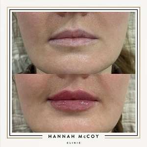 HOW LONG DOES IT TAKE FOR LIP FILLER TO SETTLE