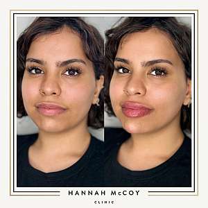 HOW TO REDUCE SWELLING AFTER LIP FILLER