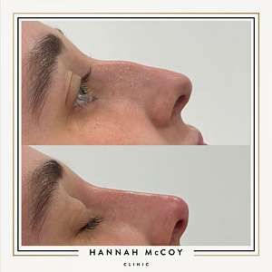 NOSE FILLER AFTERCARE 5 AFTERCARE TIPS TO FOLLOW