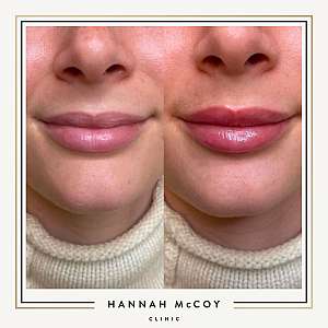 HOW TO PREPARE FOR LIP FILLERS HANNAH MCCOY CLINIC