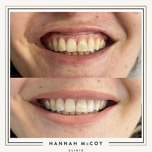Anti Wrinkle Treatment Before And After 4