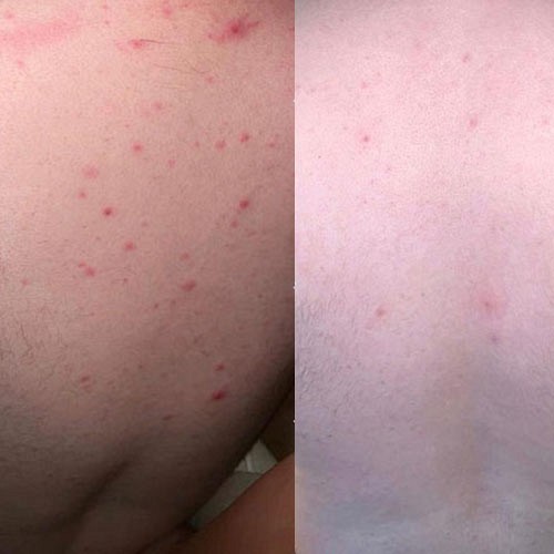 Chemical Skin Peel before and After 2