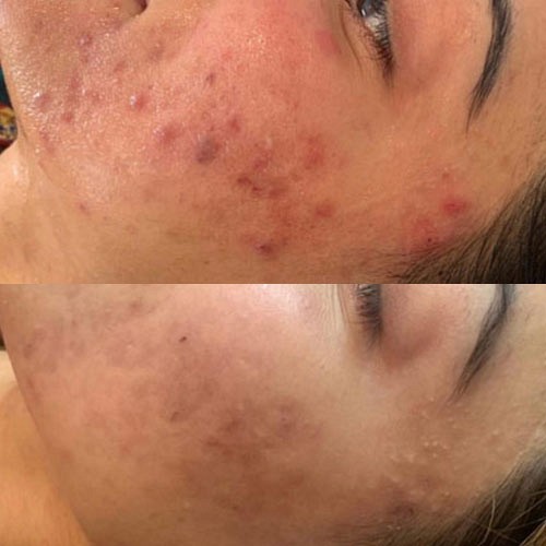 Chemical Skin Peel before and After 3