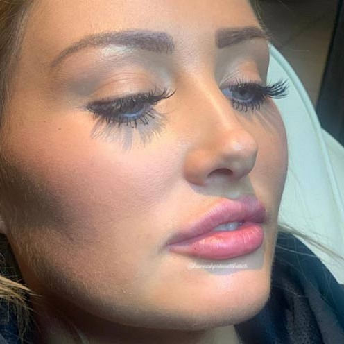 Anti Wrinkle Treatment Before And After 1