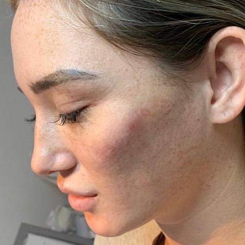 Anti Wrinkle Treatment Before And After 2