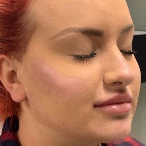 Anti Wrinkle Treatment Before And After 3