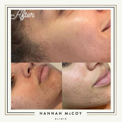 Chemical Skin Peel before and After 1