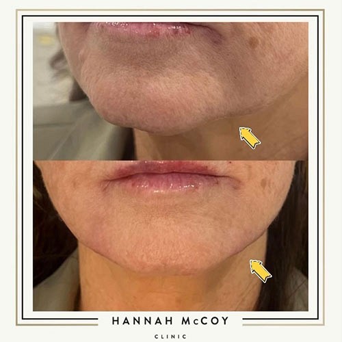 Jawline Enhancement before and After 2