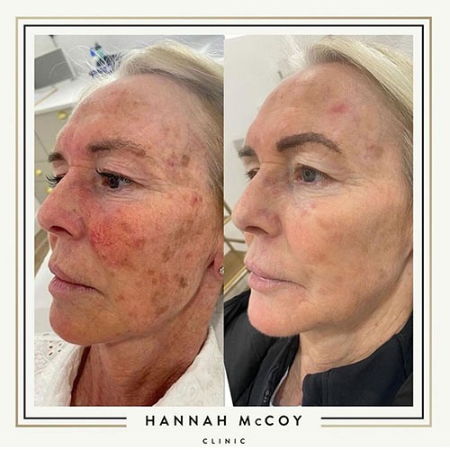 Lumecca Treatment 1