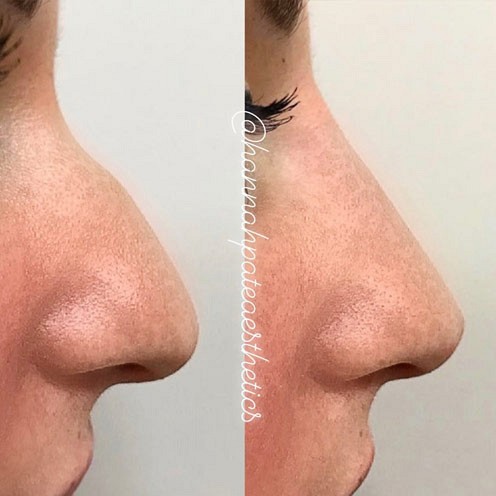 Nose Filler Client Pic 12