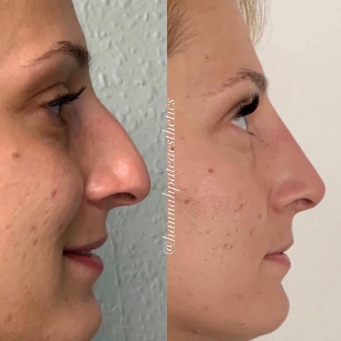 Nose Filler Client Pic 4