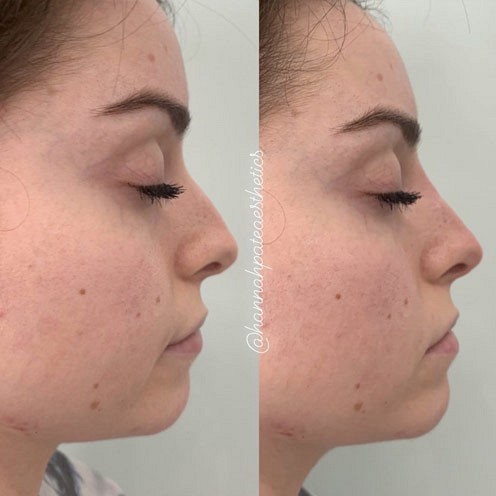 Nose Filler Client Pic 6