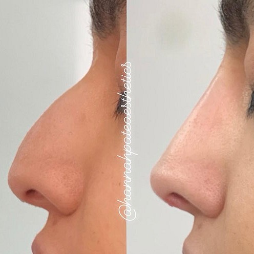 Nose Filler Client Pic 8