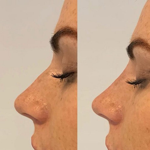 Nose Filler Client Pic 9