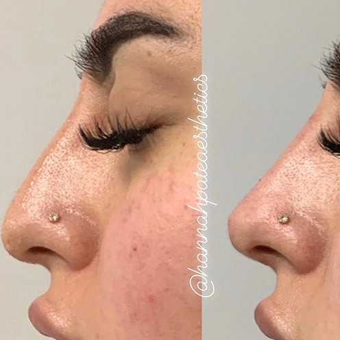 Nose Filler Client Pic 7