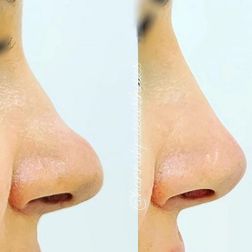 Nose Filler Client Pic 10