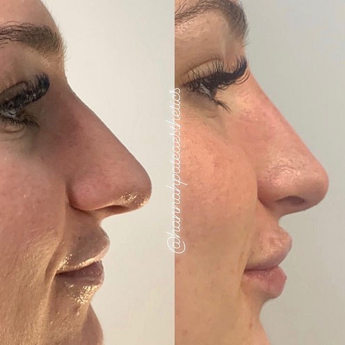 Nose Filler Client Pic 11