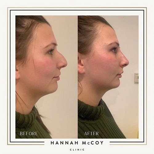 Nose Filler before and After 2