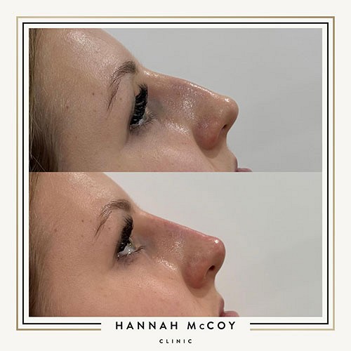 Nose Filler before and After 4