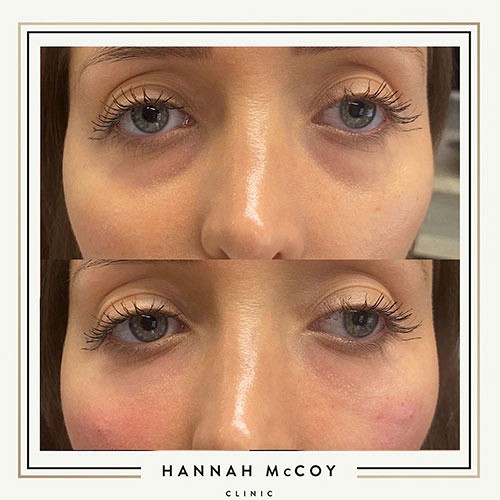 Nose Sculpting before and After 7