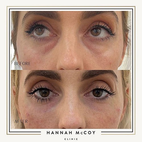 Nose Sculpting before and After 6