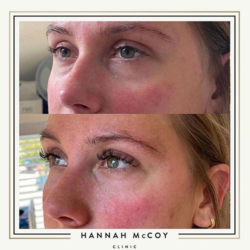 Nose Sculpting before and After 5