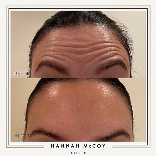 Antri Wrinkle Treatment Before And After 1