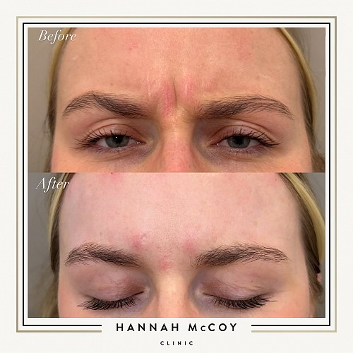 Antri Wrinkle Treatment Before And After 10