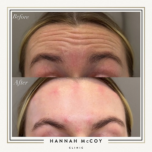 Antri Wrinkle Treatment Before And After 11