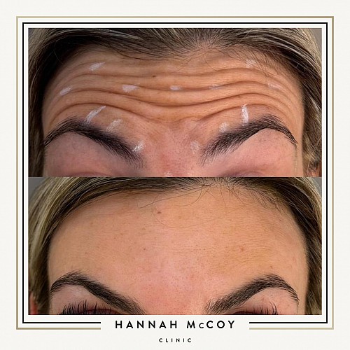 Anti-Wrinkle Treatment 1