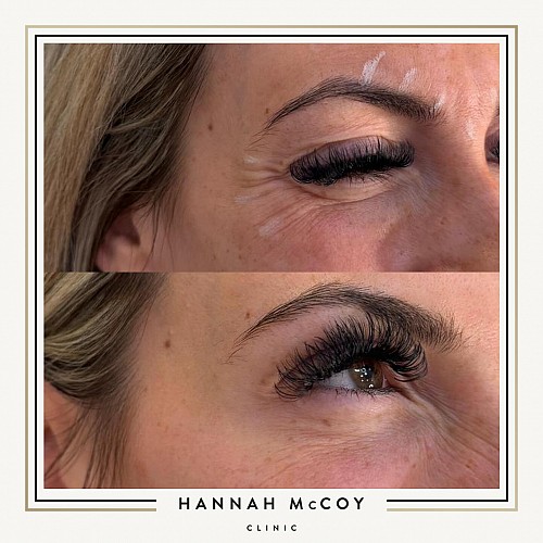 Anti-Wrinkle Treatment 3