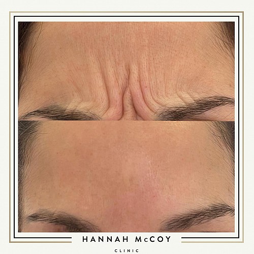 Antri Wrinkle Treatment Before And After 3