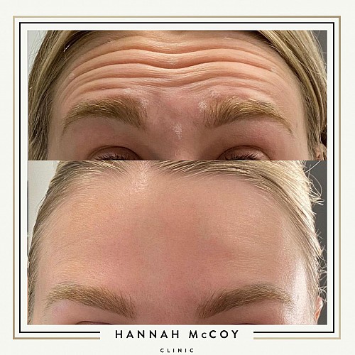 Antri Wrinkle Treatment Before And After 4