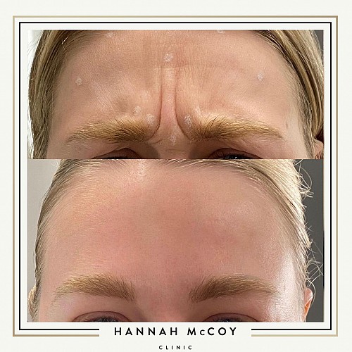 Antri Wrinkle Treatment Before And After 5