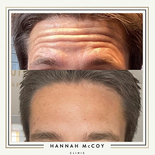 Anti-Wrinkle Treatment 2