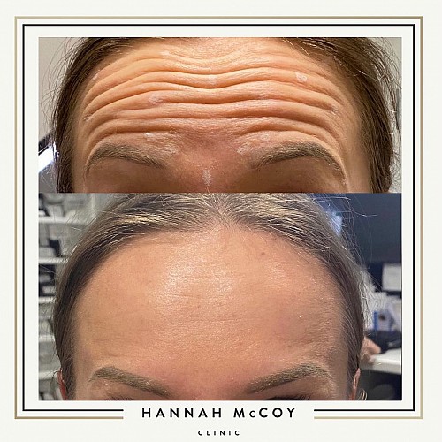 Antri Wrinkle Treatment Before And After 7