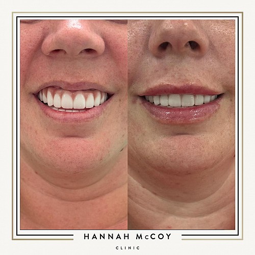 Antri Wrinkle Treatment Before And After 9